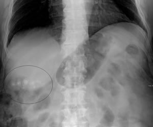 Gallstones