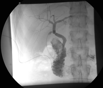 Cholangiogram