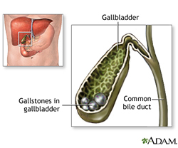 Gallstones in Gallbladder